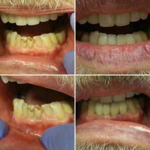 Before And After A Smile Restoration