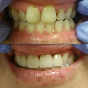 Before And After Of A Cleaned And Bightened Smile