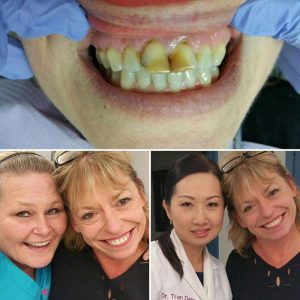 Before And After Of Teeth Whitening