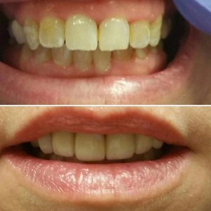 Before And After Showing A Restored Smile