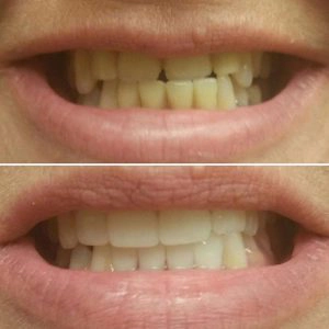 Before And After Showing Gapped Teeth Brought Into A Nice Smile