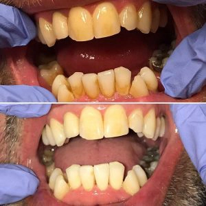 Before And After Showing Plaque Removal