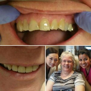Before And After Showing Repair Of Chipped Teeth
