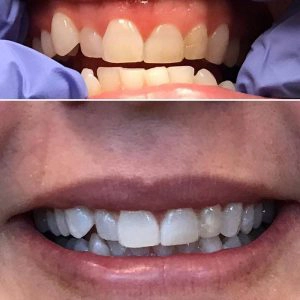 Before And After Showing The Effects Of Whitening