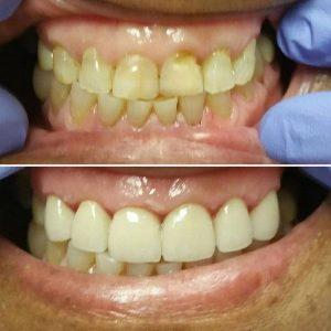 Before And After Showing The Repair Of Cracked Front Teeth