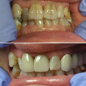 Before And After Showing The Repair Of Cracked Teeth