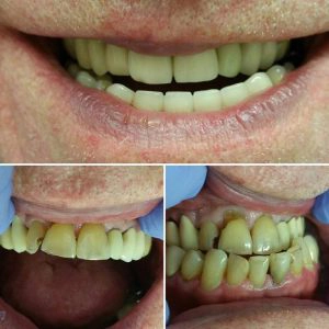 Before And After Teeth Alignment And Bleaching